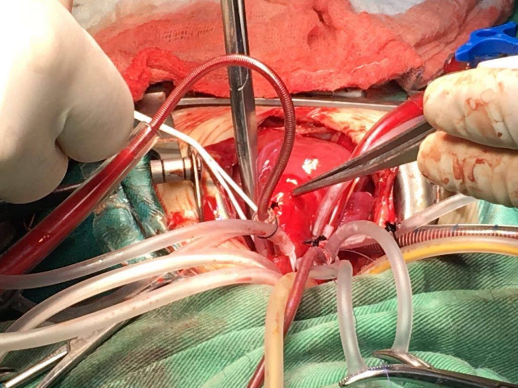 سابقة عالمية .. جراحون أمريكيون ينجحون في زراعة قلب خنزير في مريض بشري – العمق المغربي